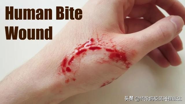 被人咬了，需要接种狂犬疫苗？一文为你说明白