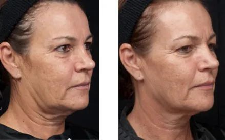 发腮发腮是什么