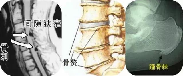 什么“骨刺”，我该怎么处理