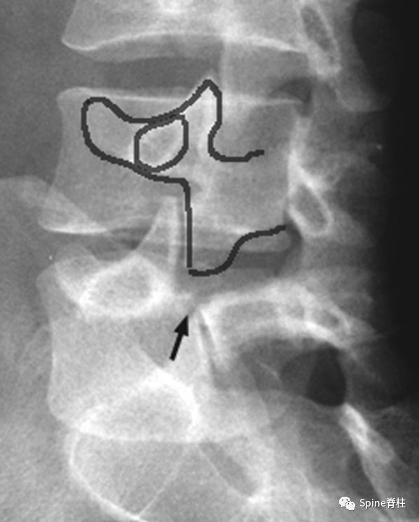 从诊断到治疗：全面解析腰椎峡部裂(lumbar spondylolysis)