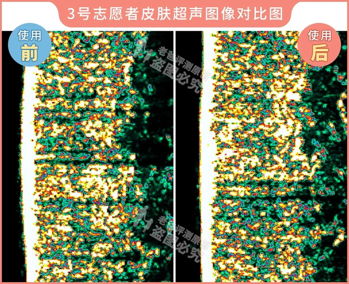 网红家用美容仪真的有效吗？2个多月的跟踪实测结果来了