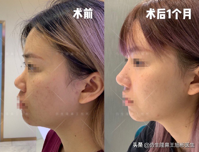 如何定义短鼻，短鼻延长后的改变有多大？