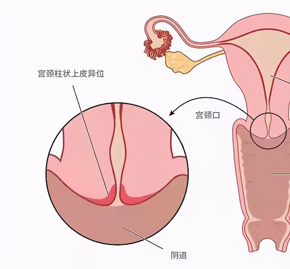 看到「宫颈糜烂」别慌,其实它根本不是病,也不用治