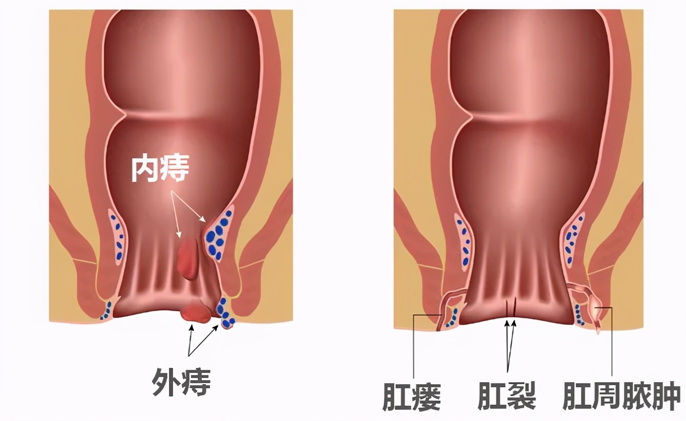 曾以为肉体疼痛的顶峰是顺产，直到做了肛瘘手术