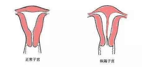 宫腔镜是个啥?有啥用?到底是检查还是手术?
