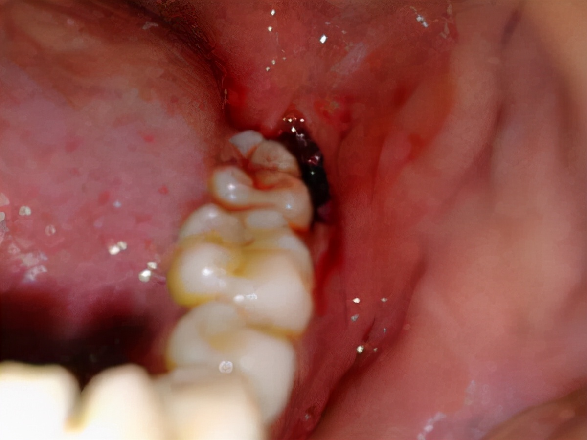 女子智齿发炎,导致脸颊烂穿!一旦出现这6个症状,赶紧看医生