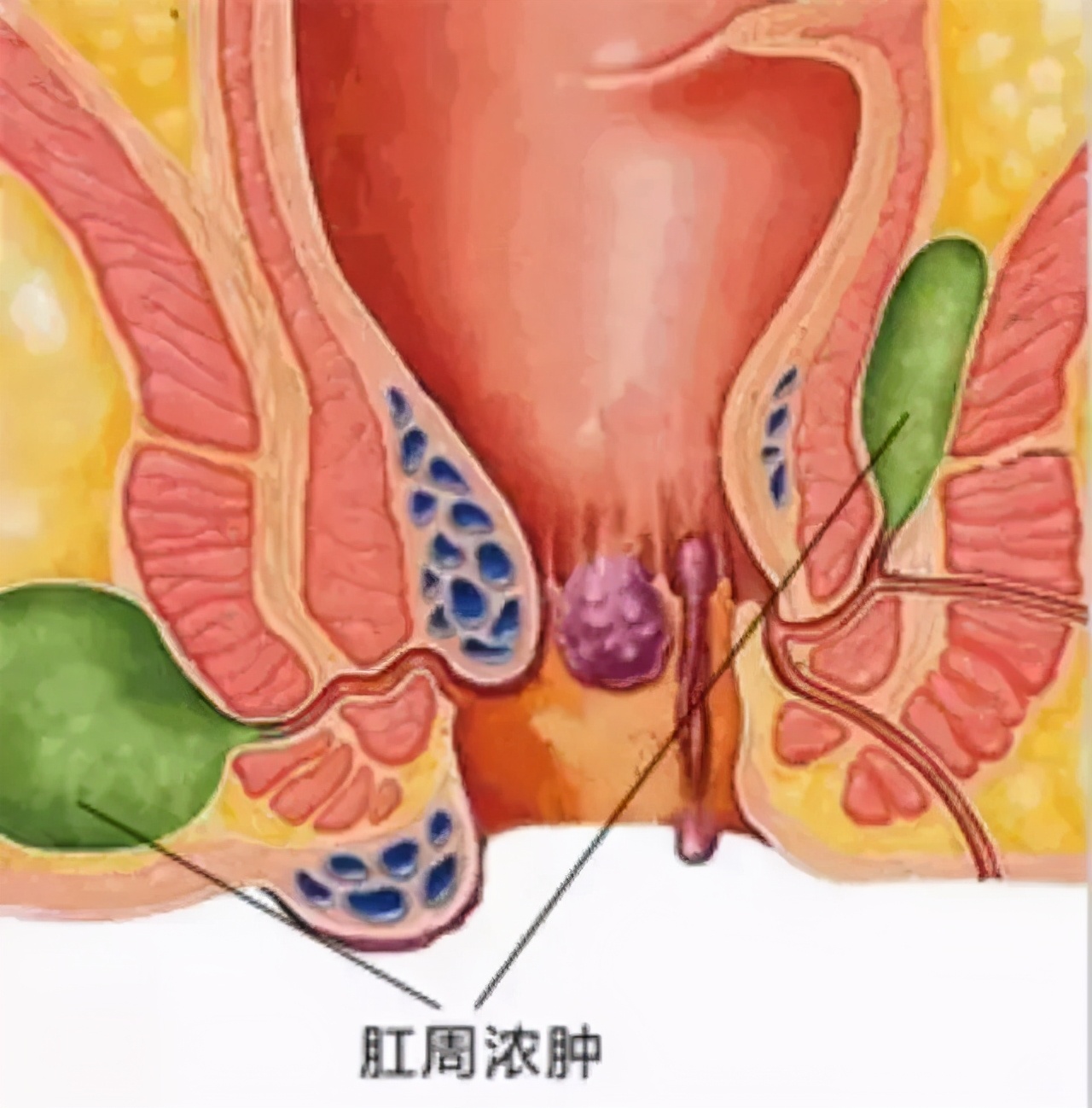 肛肠科患者与医生的真实对话，还原肛瘘的真相，让你不走弯路