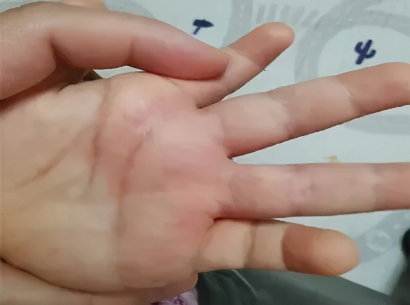 孩子手上起很痒的小疙瘩，是什么？怎么办？