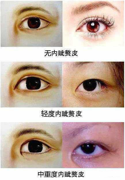 如何让眼睛从小变大?难道只是少个双眼皮?