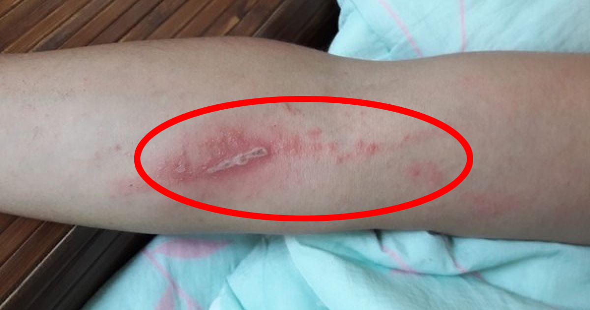 人们谈之色变的隐翅虫真的可怕吗?也许我们误会了它