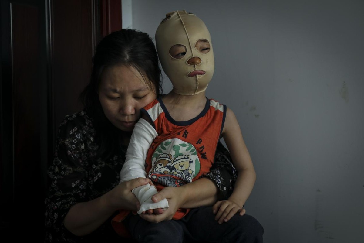 幼儿意外跌入开水盆严重烫伤,如今成"面具男孩",母亲追悔莫及