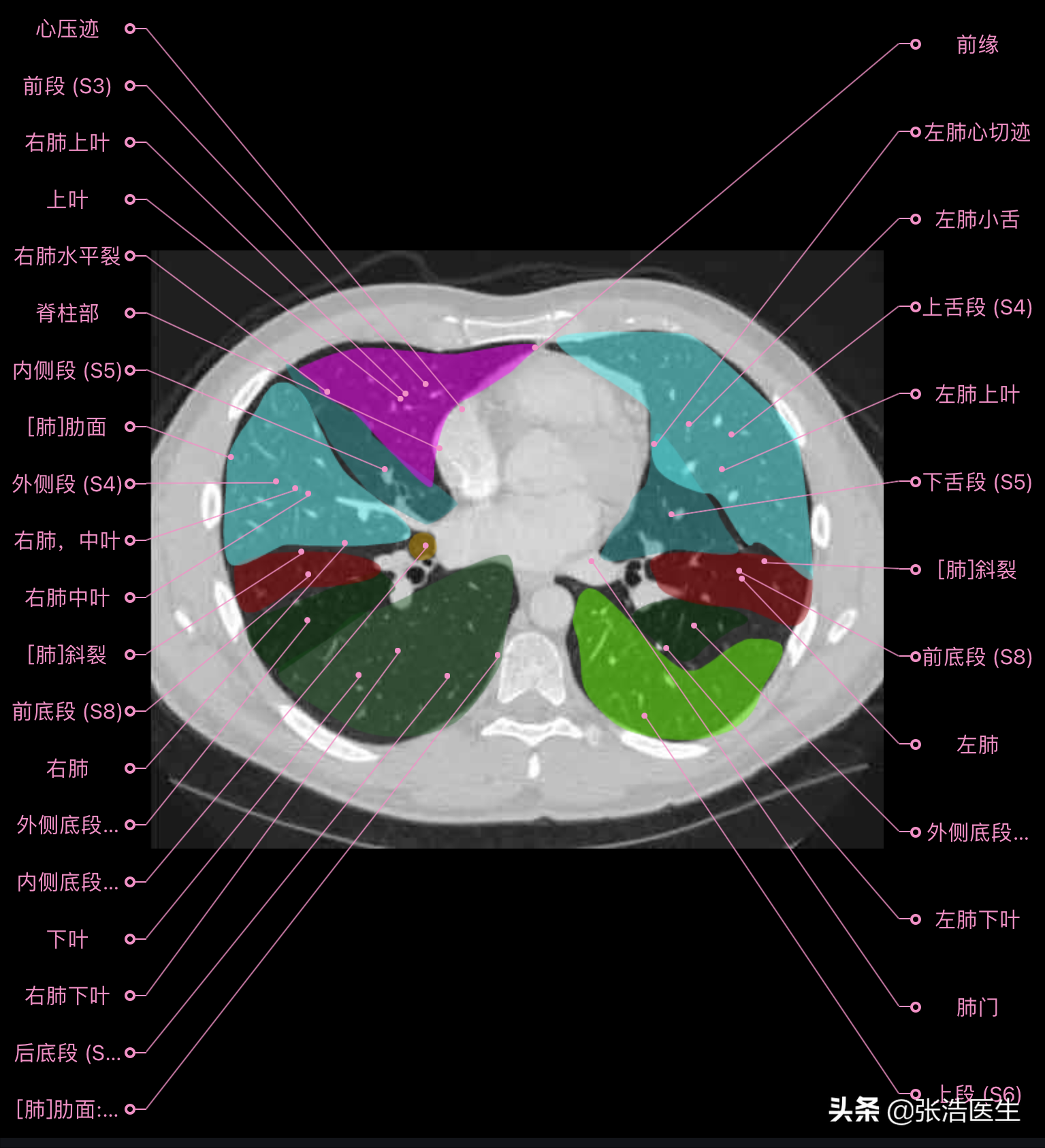 肺ct分叶分段解剖图图片