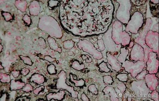 治痛风用药降尿酸需定期做什么检查？六项指标及时发现肾脏问题