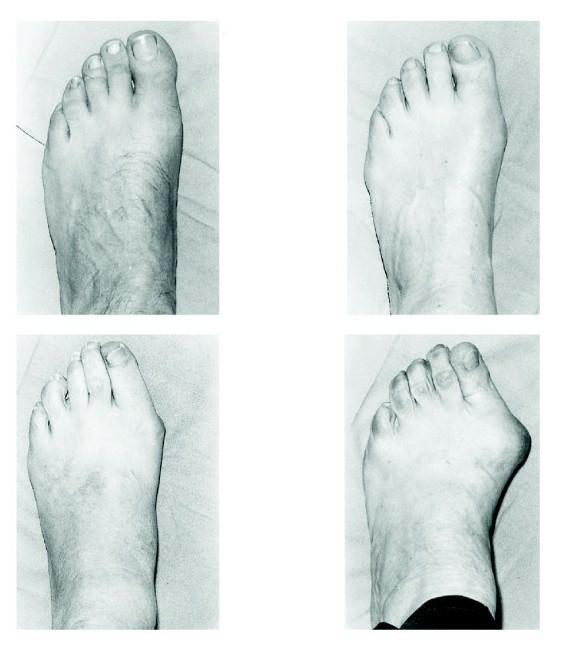 大脚拐,大脚趾内侧疼痛,要警惕:拇(趾)外翻,拇囊炎