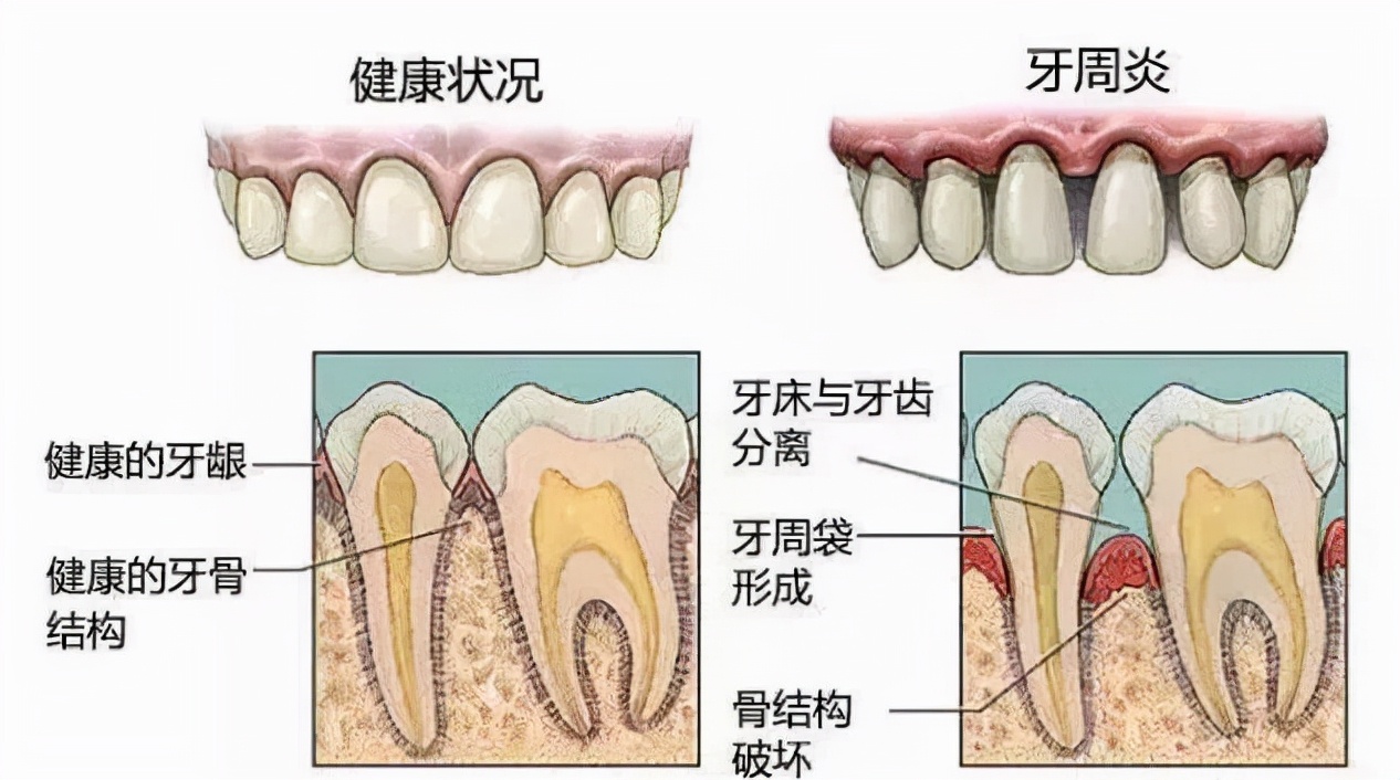 「牙齿那些事儿」No.37丨缺牙修复选种植牙，但这7类人要谨慎