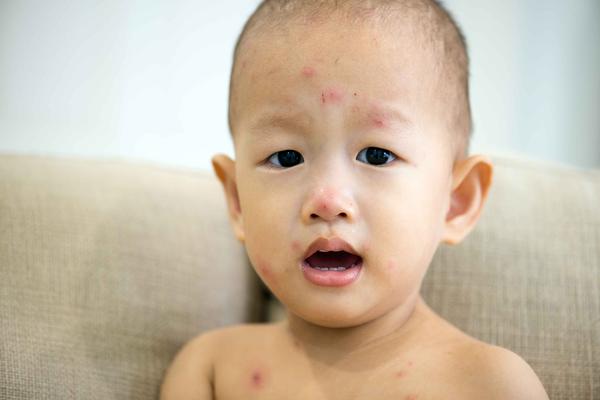 水痘的症状和治疗图片，初期和潜伏期的症状？