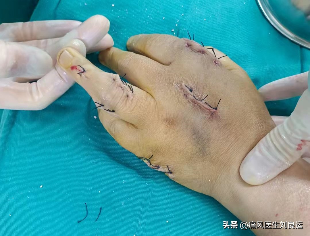 饮食清淡却患上痛风这种“富贵病”，26岁小伙用针挑破痛风石