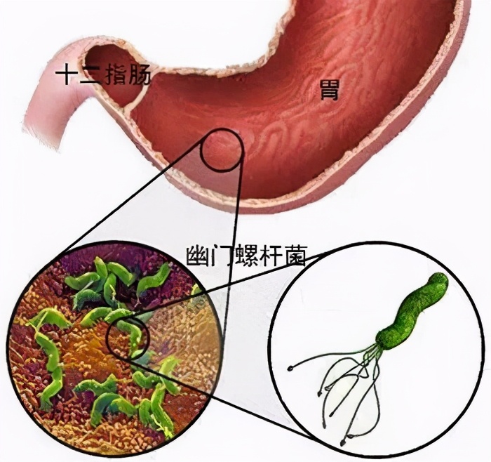 老胃病，可能是幽门螺杆菌在作怪！中西医联合治疗，效果更好