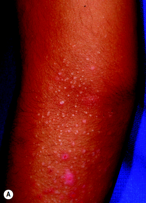 沙土性皮炎:手背上的苔藓样丘疹,来自1沙土性皮炎,来自2沙土性皮炎,来