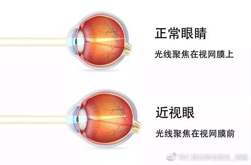 近视眼如何通过自然方法改善视力（非手术途径）