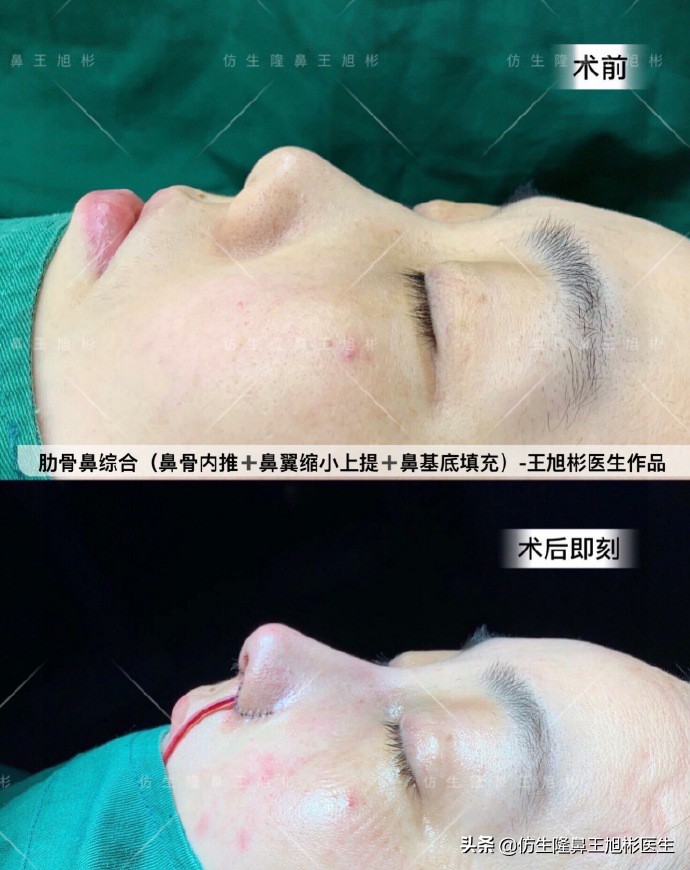 如何定义短鼻，短鼻延长后的改变有多大？