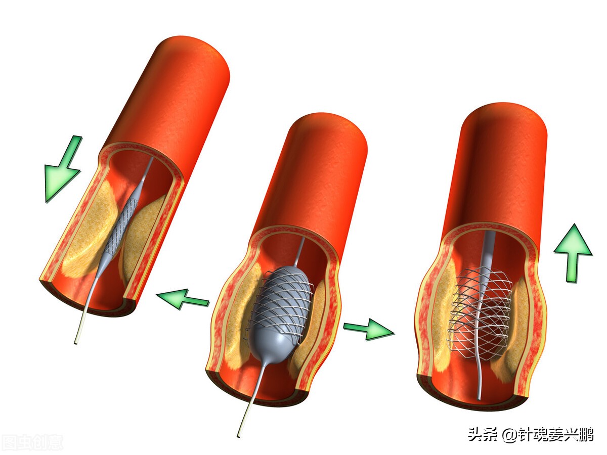 脑血管堵了怎么办？除非2种情况，中西医保守治疗效果好、花钱少