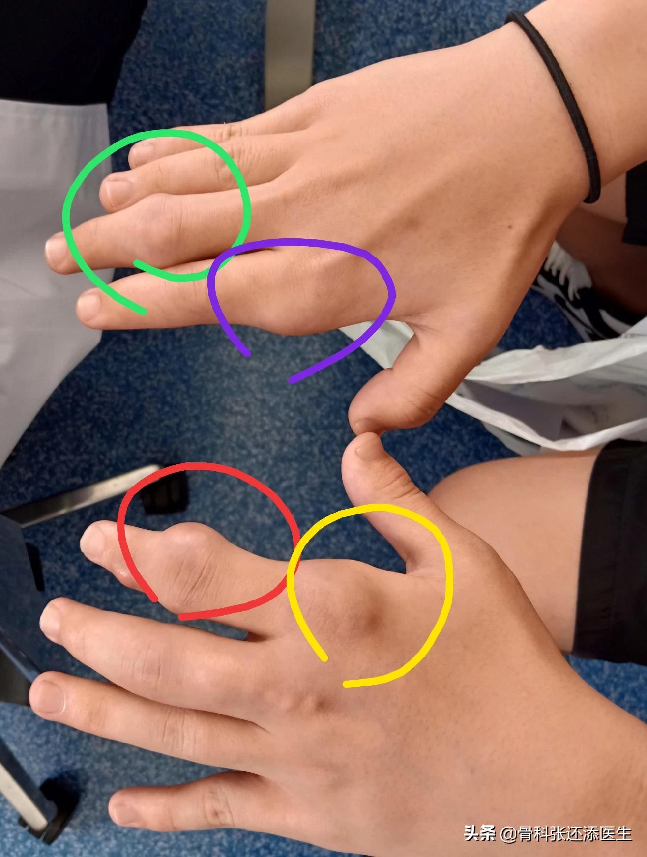 医生从我体内取出一盆石头，都是痛风惹的祸！痛风石怎么治疗？