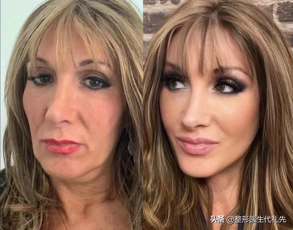 从整形医生角度谈一谈人中长显老，该如何改善？