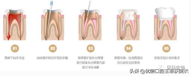 为啥根管治疗这么贵，是不是被坑了？