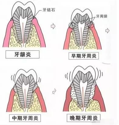 普通洗牙200，深度洗牙3000！深度洗牙是忽悠还是真的？