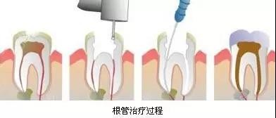 补牙“油水”有多大？如果想看牙省钱，请一字不落地看完