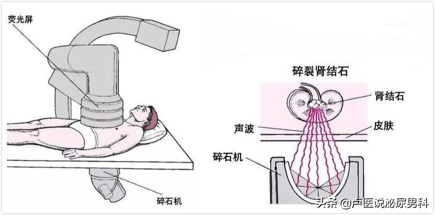 如果你患有尿路结石，准备通过“体外冲击波碎石”治疗，请看此文