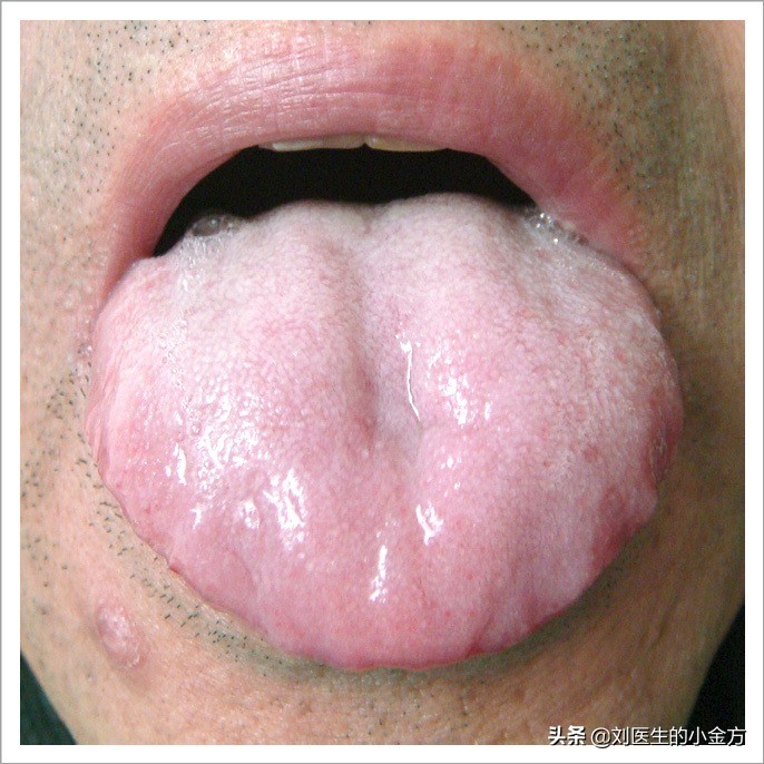 阴虚舌苔图片(中医舌诊) - 赤虎壹号