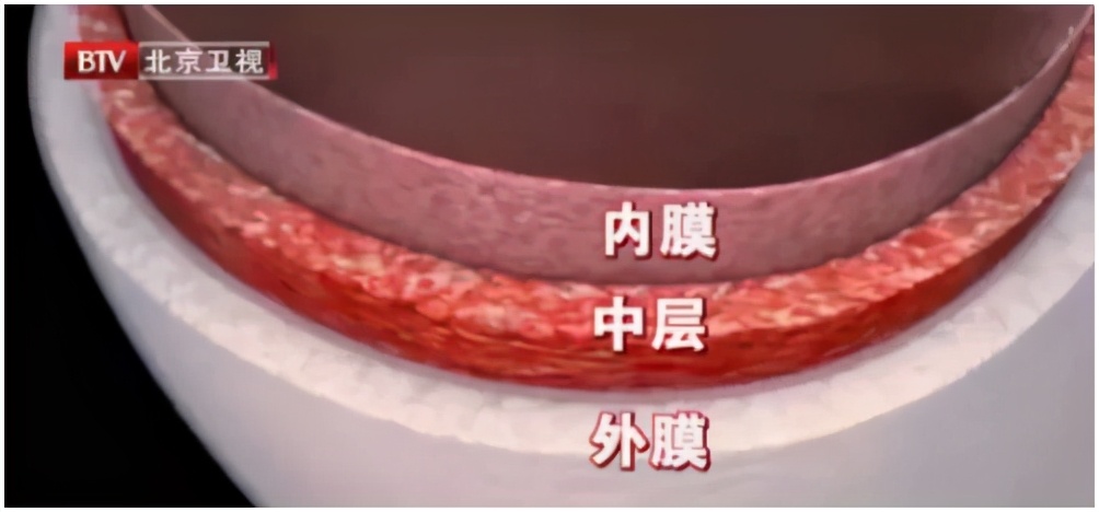 颈动脉斑块能逆转？满足3个条件，常吃“3+3+2”，调血脂、控斑块，血管更健康