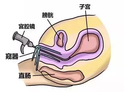 医生,我好好的宫腔怎么就粘连了呢?