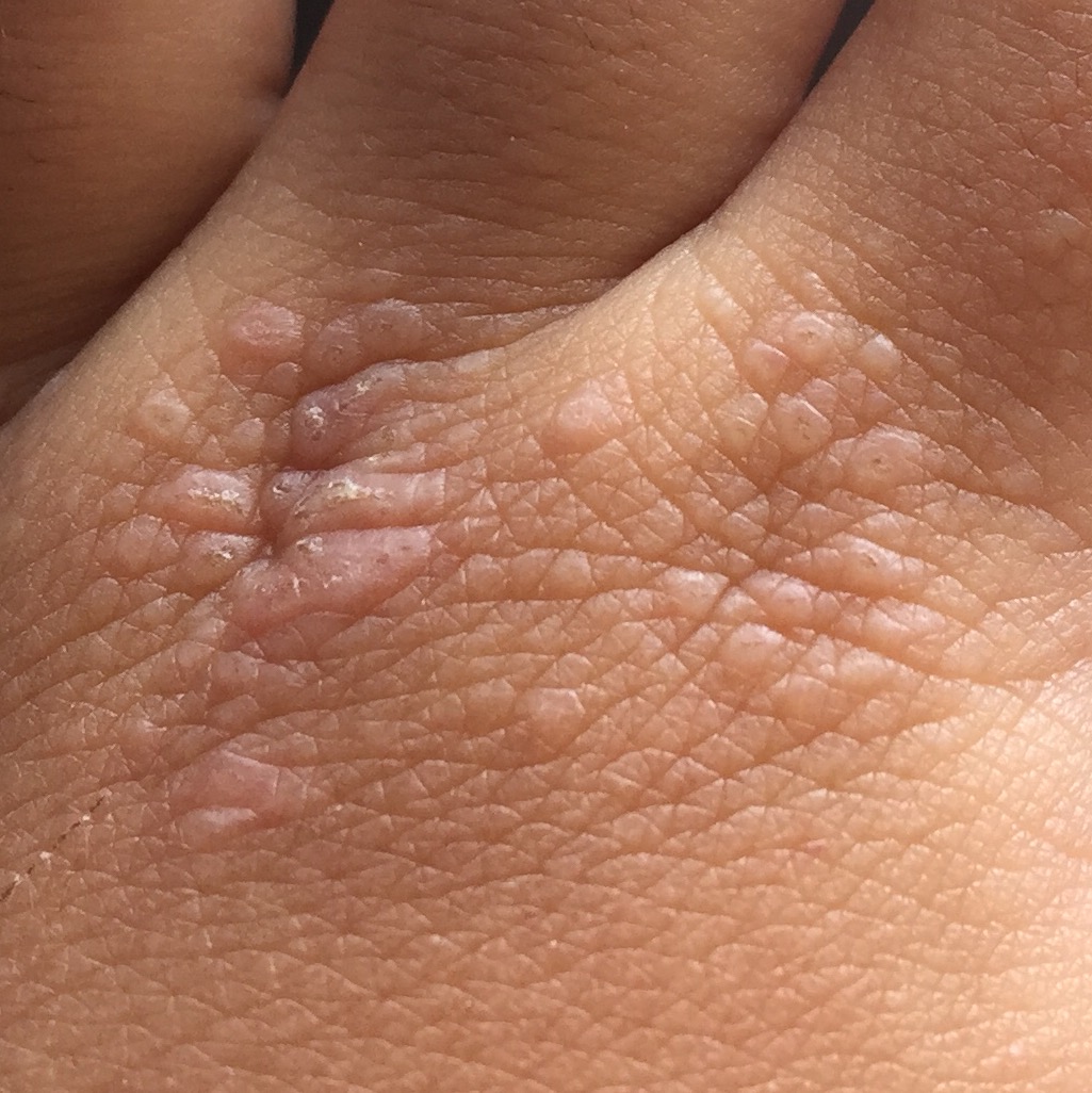 夏天到来,小朋友的皮肤出现小丘疹,这是什么病?