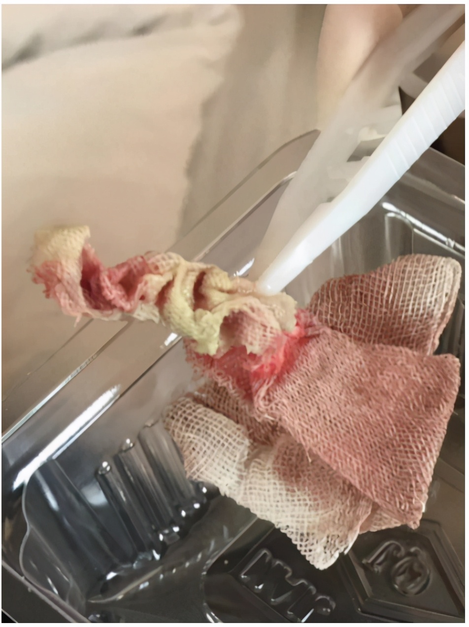 入院后给予换药创口引流纱条深度约3.