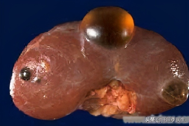 肝上有囊肿严重吗肝脏上有囊肿该怎么办能自愈吗