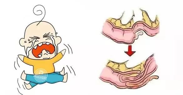 宝宝莫名哭闹可能是肠子“打结”了！千万别大意