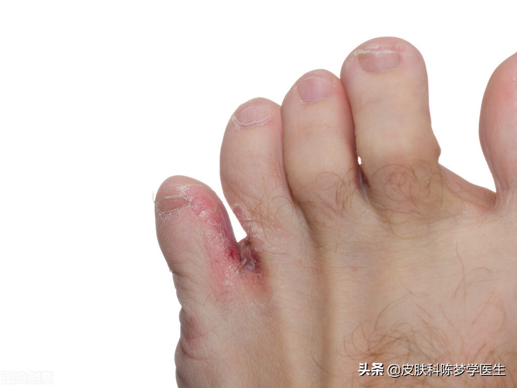 十几年的老脚气，反反复复老不好该怎么办？