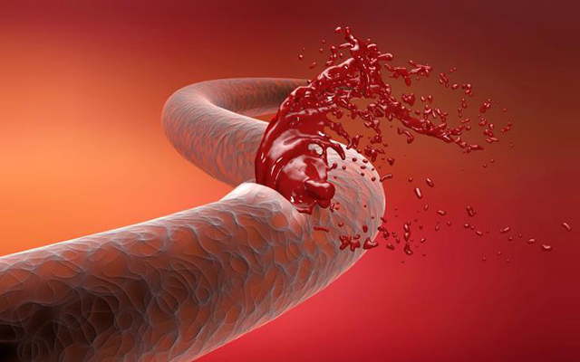 中医院资深紫癜专家表示,过敏性紫癜的皮疹主要是由于毛细血管破裂,血