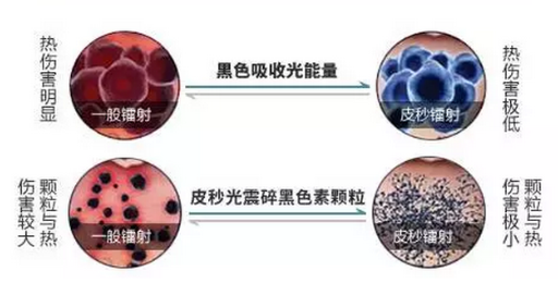 皮秒激光祛斑会反黑、皮肤变薄吗？内行人告诉你真相是这样