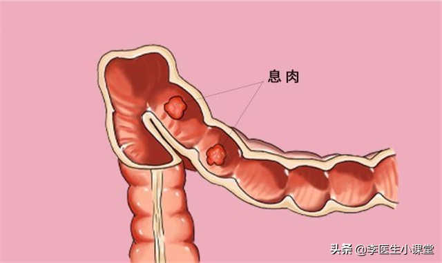 医生提醒：肠息肉切除后，饮食上做到这几点，伤口好得更快