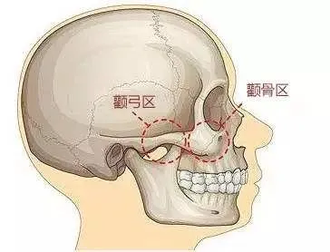 颧骨外凸、面部线条看着很突兀！80%的人是因为这2个因素