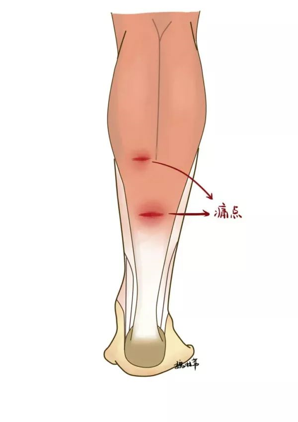 为网球腿,不过现在已将小腿三头肌损伤所导致的临床表现统称为网球腿