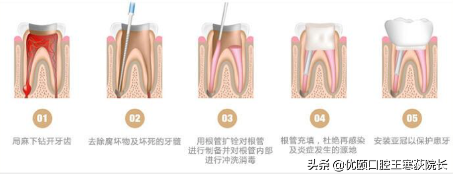 为啥根管治疗这么贵，是不是被坑了？