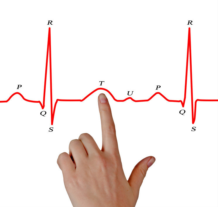 心电图t波改变是怎么回事儿?就是冠心病吗?