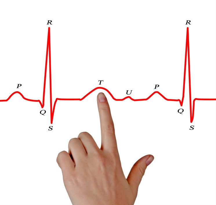 心電圖t波改變是怎麼回事兒?就是冠心病嗎?