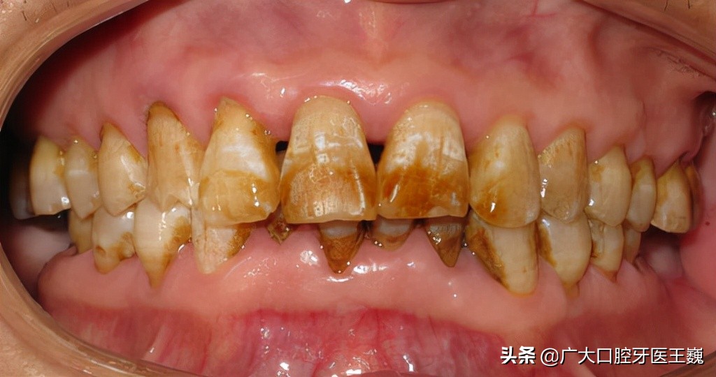 全瓷牙和烤瓷牙哪个好区别在哪全瓷牙和烤瓷牙如何选择
