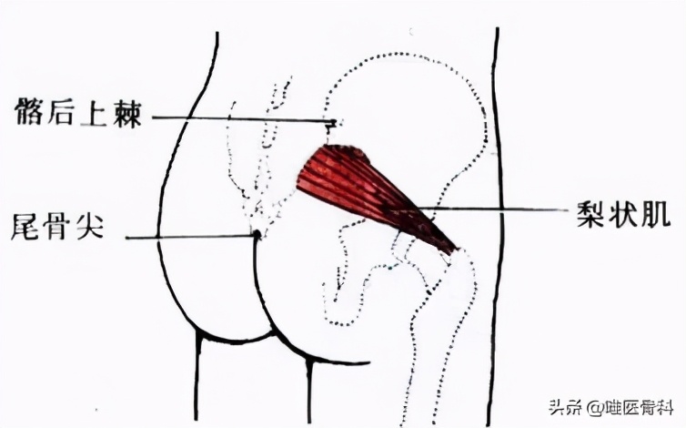 坐骨神经痛是什么引起的(为什么会「坐骨神经痛」？两大原因，一招区分)